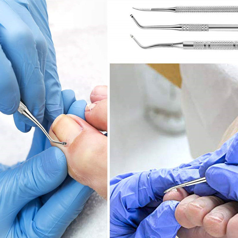 3 pièces outil d&#39;ongle incarné en acier inoxydable, lime et élévateurs d&#39;ongles, kit d&#39;outils de pédicure de traitement chirurgical sûr professionnel des ongles outils de nettoyage des ongles soulagement de la douleur