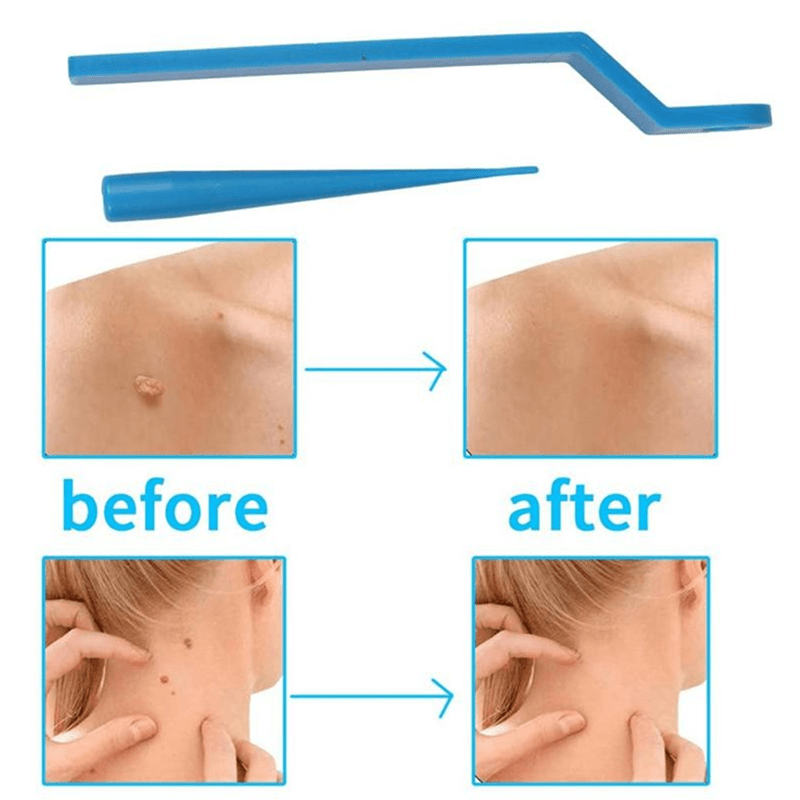 10Pcs \ u002FSet Skin Tag Kill Skin Mole Wart Remover, Micro Skin Tag Removal Kit con hisopos de limpieza, Adult Mole Wart Face Care Tools